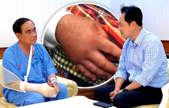 PM hospitalised with chronic arthritic condition which impacts 3% of people aged over 60 years old