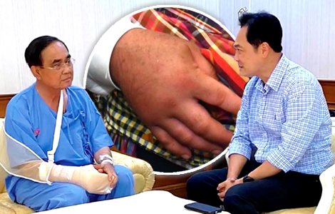 PM Prayut hospitalised with chronic arthritic malady that impacts 3% of people over 60 - Thai Examiner 4 pm-hospitalised-with-chronic-arthritic-malady